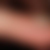Pincer-Nail:&nbsp; Seitliche Ansicht mit der Zeltdach-artig aufgewölbten Nagelplatte.
