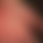 Erythema palmare et plantare symptomaticum. Übersichtsaufnahme: Unscharf begrenzte, flächige Rötu...
