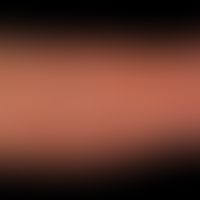 UV-Strahlen: Chronischer UV-Schaden mit enormer Voralterung der Haut (Streckseite des Unterarms),...