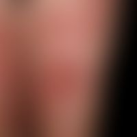 Pemphigoid gestationis: Large, partly sharply defined and partly blurred, bright red plaques with...