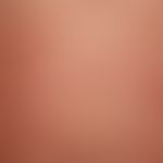 Pemphigoid gestationis. Heftig juckendes, seit 4 Wochen bestehendes &nbsp;Exanthem mit multiplen,...