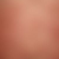 Pemphigoid gestationis. itchy, since 4 weeks existing exanthema with multiple, generalized, symme...