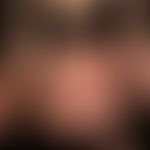 Pemphigoid gestationis:&nbsp;heftig juckendes, seit 4 Wochen bestehendes &nbsp;Exanthem mit multi...