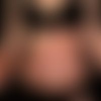 Pemphigoid gestationis: Intensely itching exanthema since 4 weeks with multiple, generalized, sym...