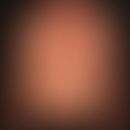 Pemphigus chronicus benignus familiaris: Multiple, chronically dynamic (changing course), little ...