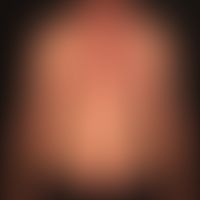 Pemphigus chronicus benignus familiaris: Multiple, chronically dynamic (changing course), little ...