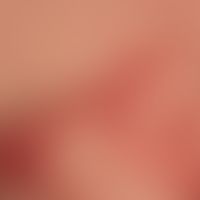 Pemphigus chronicus benignus familiaris. Randbereich: Multiple krustig belegte, scharf begrenzte,...