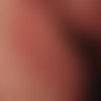Pemphigus chronicus benignus familiaris: Clinically inconclusive findings (pre-treatment) with hi...
