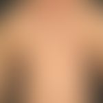 Pemphigus vulgaris (Stadium derGeneralisation): multiple, chronische, seit 3 Jahren schubweise ve...