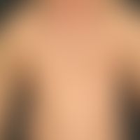 Pemphigus vulgaris (Stadium derGeneralisation): multiple, chronische, seit 3 Jahren schubweise ve...
