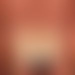 Psoriasis of the nails: periungual, chronic stationary (little exudative) psoriasis with psoriati...