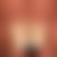 Psoriasis of the nails: periungual, chronic stationary (little exudative) psoriasis with psoriati...