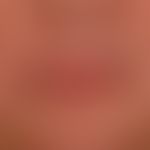 Perlèche: Severe chronic cheilitis (in atopic diathesis) with inflammation of both sides of the m...