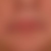 Perlèche: Schwere chronische Cheilitis (bei atopischer Diathese) mit beidseitigen Mundwinkelentzü...