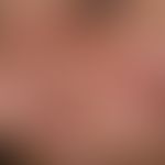 Rosacea type III (glandular hyperplastic rosacea): Phymic transformation of the cheeks and nose: ...