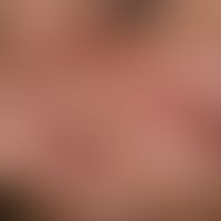 Rosacea type III (glandular hyperplastic rosacea): Phymic transformation of the cheeks and nose: ...