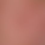 Comedones: encircled a group of shotgun-like comedones of different sizes; arrow horizontal point...
