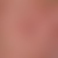 Comedones: encircled a group of shotgun-like comedones of different sizes; arrow horizontal point...