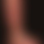 Lymphedema: chronic lymphedema in recurrent erysipelas with pronounced verrucous transformation o...