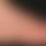 Tinea pedis "Mokassin-Typ":&nbsp; Wenig entzündliche Mykose des Fußes. Pfeile bezeichnen die prox...