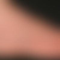 Tinea pedis "Mokassin-Typ":&nbsp; Wenig entzündliche Mykose des Fußes. Pfeile bezeichnen die prox...