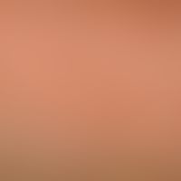 Lichen myxoedematosus: Densely standing, skin-colored, also light-glassy appearing, clearly incre...
