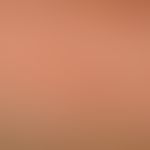 Lichen myxoedematosus: Densely standing, skin-colored, also light-glassy appearing, clearly incre...