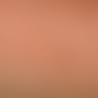 Lichen myxoedematosus: Densely standing, skin-colored, also light-glassy appearing, clearly incre...