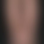 Secondary lymphedema with complicative leukocytoclastic vasculitis; condition following hysterect...