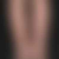 Sekundäres Lymphödem mit komplikativer leukozytoklastischer Vaskulitis. Zustand nach Hysterektomi...