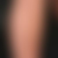 ILVEN: acquired, inflammatory, Blaschko-linear dermatosis in a 12-year-old girl; spontaneous resi...