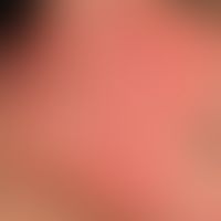 Rosacea erythematosa:&nbsp; flächenhafte und gleichmäßige Rötung beider Wangen durch Ausbildung m...