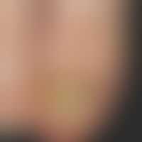 Onychogrypose: seit&nbsp;einigen Jahren unförmig verdickter, gelblicher Großzehennagel bei einem ...