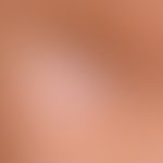 Lipoatrophie, lokalisierte nach Glukokortikosteroid-Injektionen. Detailvergrößerung: Kreisrundes ...
