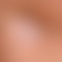 Lipoatrophie, lokalisierte nach Glukokortikosteroid-Injektionen. Detailvergrößerung: Kreisrundes ...