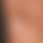 Lipoatrophie, lokalisierte nach Glukokortikosteroid-Injektionen. Übersichtsaufnahme: 2,5 x 3,0 cm...
