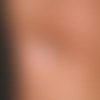 Lipoatrophie, lokalisierte nach Glukokortikosteroid-Injektionen. Übersichtsaufnahme: 2,5 x 3,0 cm...