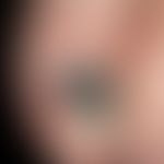 Nagelhämatom: seit exakt 6 Wochen bestehende (Trauma erinnerlich), scharf nach vorne begrenzte bl...