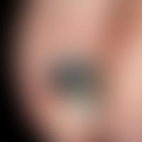 Nail hematoma: since exactly 6 weeks existing (trauma reminding), sharply forward limited blue-bl...