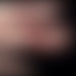 Acute paronychia: blistery, circumferential, painfully throbbing paronychia (bulla repens) that h...