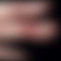 Akute Paronychie: seit wenigen Tagen bestehende blasige, umlaufende, schmerzhaft pochende&nbsp;Pa...