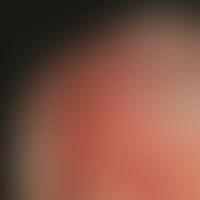 Pemphigoid bullöses, vernarbendes, Typ Brunsting-Perry. Dei selbe Patientin nach 3-monatiger immu...