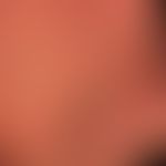 Psoriasis palmaris et plantaris. dry keratotic plaque type. non pretreated psoriasis palmaris. in...