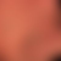 Psoriasis palmaris et plantaris. Trocken-keratotischer Plaque-Typ. Nicht vorbehandelte Psoriasis ...