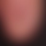 Pterygium unguis: The scarred adhesions of the proximal nail fold are clearly recognizable; condi...