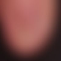 Pterygium unguis: The scarred adhesions of the proximal nail fold are clearly recognizable; condi...