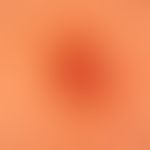 POEMS Syndrome: Incident light microscopy. Regular, reticular pattern of the reteleistn. Capillar...