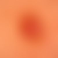 POEMS Syndrome: Incident light microscopy. Regular, reticular pattern of the reteleistn. Capillar...