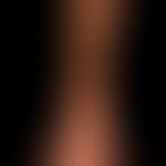 POEMS syndrome: flat, even hyperpigmentation with "scleroderma-like" hardening and swelling of th...