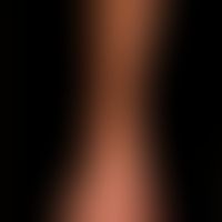 POEMS syndrome: flat, even hyperpigmentation with "scleroderma-like" hardening and swelling of th...